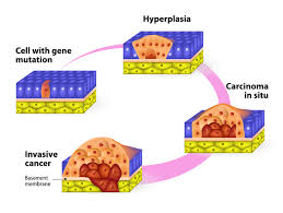 Some types of skin cancer are more dangerous than others, but if you have a spot. Melanoma Medlineplus Genetics