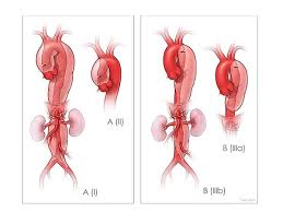 Image result for Aortic Dissection
