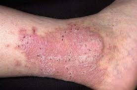 This is caused due to excessive scratching of the skin. Lichen Simplex Chronicus Erkrankungen Der Haut Msd Manual Profi Ausgabe