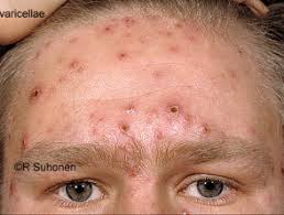 Just how long do we have until they're spoiled? Chickenpox Dermnet Nz