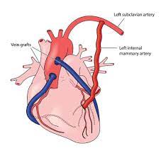 In human anatomy, the internal thoracic artery (ita), previously commonly known as the internal mammary artery (a name still common among surgeons), is an artery that supplies the anterior chest wall and the breasts. Coronary Artery Grafts Using Veins And The Left Internal Mammary Artery Tasmeemme Com