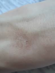 Ай нид хэлп! Что это за паразиты? | Пикабу