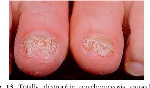 Image result for onychomycosis