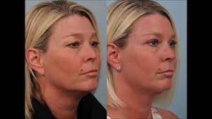 Female Upper Eyelid Sliver Blepharoplasty By Dr Edwin Williams Upper Eyelid Heavy Eyelids Eye Lid Surgery