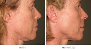 Want to take a decade off your face? Ultherapy Lower Face And Jowls Treatments Smooth Synergy Medical Spa Laser Center