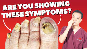 4 SYMPTOMS OF FOOT FUNGUS!
