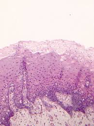 Image result for Leukoedema