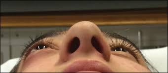 Image result for Proptosis