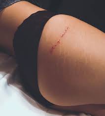They look like scars. meryn glanced down and realized he was talking about her stretch marks. Lingerie Woman And Bodypositivity Image 6493833 On Favim Com