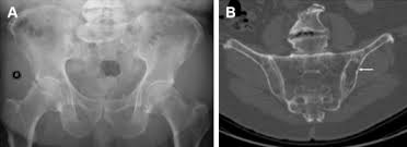 International myeloma working group molecular classification of multiple myeloma: Whole Body Imaging In Multiple Myeloma Magnetic Resonance Imaging Clinics
