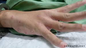 Image result for what does scabie look like