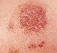 Staphylococcus aureas and group a streptococcus both cause skin infections that are regularly mistaken for spider bites. Identify Bug Bites Common Bug Bites Orkin