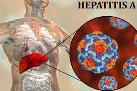 'hepatitis' adalah istilah medis yang menggambarkan peradangan hati. Hepatitis A Gejala Penyebab Dan Cara Mengobati Idn Medis