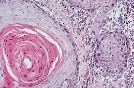 When your cancer markers are higher than normal it usually indicates cancer in your body or blood and can usually be cured when caught soon enough. Tumor Markers Definition And Examples