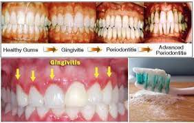 6 Best Natural Remedies For Gingivitis Gingivitis Is An Infection Of The Gums That Affects Almost Everyon Gum Disease Treatment Gingivitis Gingivitis Remedies
