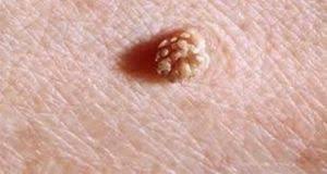 الثاليل التواليل التناسلية فيروس الورم الحليمي البشري وطرق علاجها بالطب البديل والأعشاب How To Treat Warts Herbs Nutrition