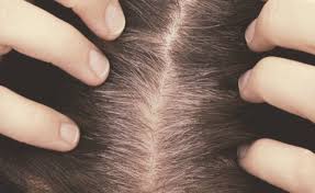 There are many reasons to stop dyeing, money, chemicals, organic lifestyle, chemo, pregnancy, tired of being a slave to something for however many years you have been dyeing and just plain want to see what nature gave you.when you have that reason, you'll need some ideas about how to get there. Natural Home Remedies To Get Rid Of Grey Hair K4 Fashion