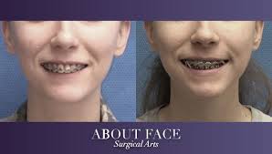 Ivro allows the jaw to find the best position without. Jaw Orthognathic Surgery About Face Surgical Arts