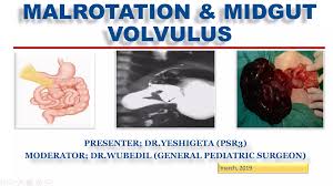 Image result for Midgut Volvulus