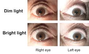 Image result for Pupillary Paralysis