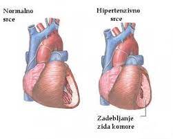 Arterijska hipertenzija – tihi ubojica, Hipertenzija srca