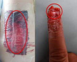 Image result for Occlusive Dressing