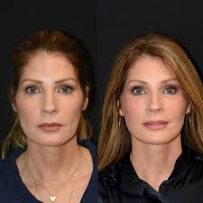 3 months after extended deep plane facelift, neck lift, fat transfer, lip  lift and lateral browlift for this beauty. She took my breath away when I  opened my office door today to