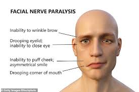 The cause of bell's palsy is unknown. Patients With Covid 19 Are Seven Times More Likely To Have Bell S Palsy Than Vaccine Recipients Daily Mail Online