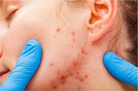 Below is a list of common medications used to treat or reduce the symptoms of severe recalcitrant nodular acne. Isotretinoin Accutane As Acne Treatment