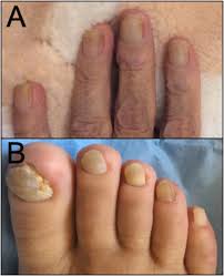 Image result for Yellow nail syndrome feet