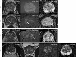 Whether you or someone you love has cancer, knowi. Diagnostic Performance Of Pi Rads Version 2 1 Compared To Version 2 0 For Detection Of Peripheral And Transition Zone Prostate Cancer Scientific Reports