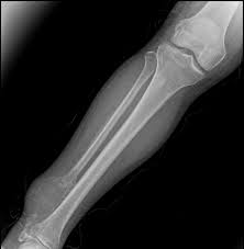 Image result for Osteosarcoma