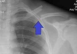 Backbone.js models are also the most important building blocks when it comes to building backbone.js applications. Clavicle Fracture Wikipedia
