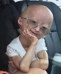 I think these proteins linked to progeria play a very profound role in the aging. The Science Behind Progeria The Progeria Research Foundation