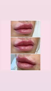 Superbly placed , what a stunning, natural transformation · 09/02/2022. Lips Of London Aesthetics A Little 0 55mls Juvederm Top Up A Year Since We Last Did These And What A Lovely Difference Only 0 5 Makes Less Is More Sometimes Taking