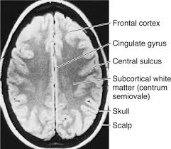 Image result for Cerebral Subcortex