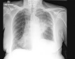 It takes pictures from different angles. Lung Cancer Left Upper Lobe Radiology Case Radiopaedia Org