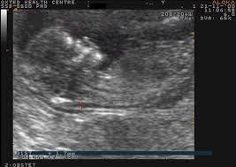 Early fetal scan (early baby scan) is an advanced version of nt scan. Nuchal Scan Diagnostic Ultrasound
