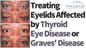 Graves' disease, also known as toxic diffuse goiter, is an autoimmune disease that affects the thyroid. How And When To Treat Eyelids Affected By Graves Disease Thyroid Eye Disease Youtube
