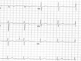 Image result for Lyme Carditis