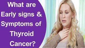 Symptoms of thyroid cancer in females. What Are The Early Signs And Symptoms Of Thyroid Cancer Youtube