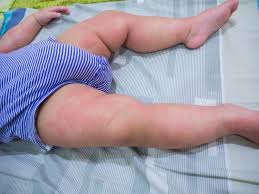 Common rash with many possible causes. 7 Signs Your Baby Has A Food Allergy What To Do When Symptoms Appear Baby Rash Baby Food Allergies Food Allergies
