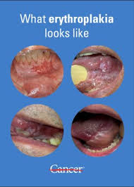 Image result for Erythroplakia roof of mouth