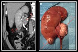 Factors that can increase the risk of ureteral cancer include: Transitional Cell Carcinoma Of The Renal Pelvis With Synchronous Ipsilateral Papillary Renal Cell Carcinoma Case Report And Review Sciencedirect