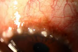 Image result for Vernal Conjunctivitis