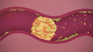 However, it may cause an allergic reaction allergic reaction if you are sensitive to psyllium. How Metamucil Works In Your Body Metamucil