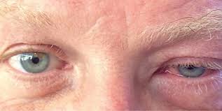 Image result for Viral Conjunctivitis