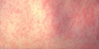 Mo. Health Department warns of possible measles exposure at Busch Stadium, local St. Louis businesses