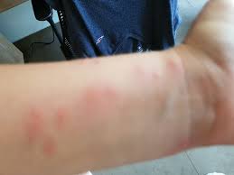 À l'âge adulte, elles mesurent de 4 à 7 millimètres de long, soit environ la taille d'un pépin de pomme. Pres De 70 Boutons De Punaises De Lit Picture Of Sunset Coin Lembongan Cottage And Spa Nusa Lembongan Tripadvisor