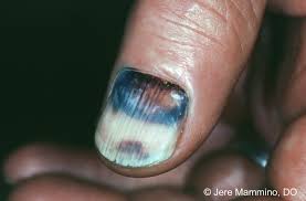 This can cause the blood vessels to break and bleed under the nail. Subungual Hematoma American Osteopathic College Of Dermatology Aocd